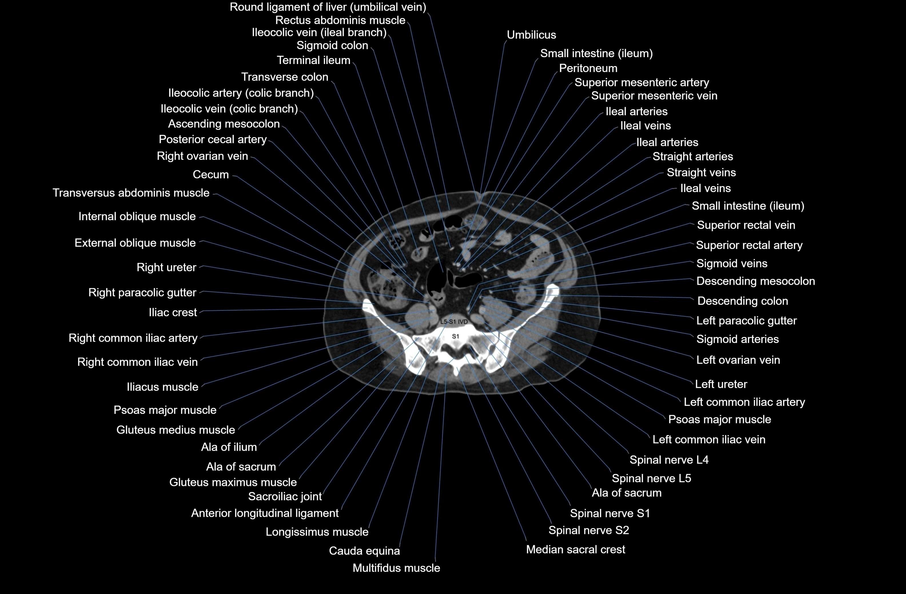 CT Abdomen axial cross sectional anatomy labelled radiology image-00065.webp